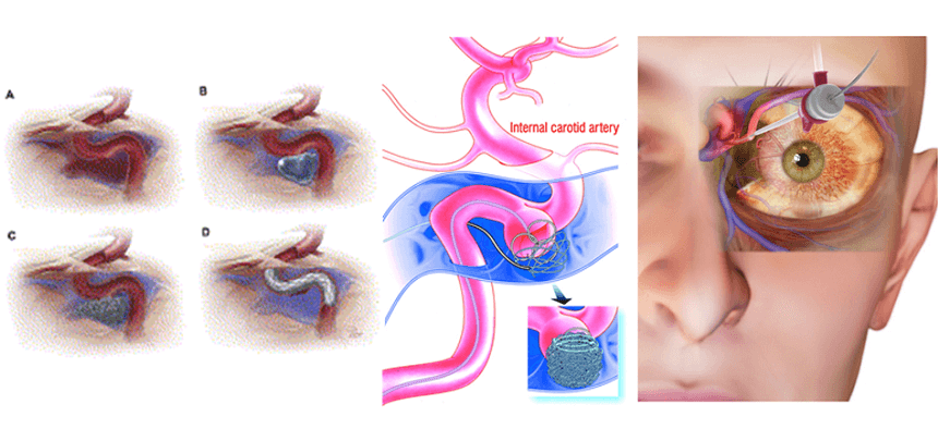 Carotid Cavernous Fistula Treatment in Pune